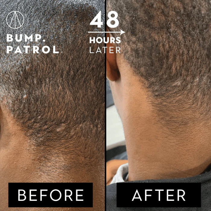 Bump Patrol - Original Aftershave Treatment (Soin après-rasage) - Image 3